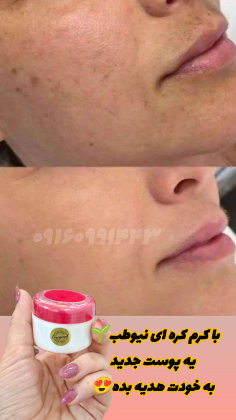 کرم شب وی آی پلاس کره ای(صددرصد اصلی) درمان سرسخت ترین لکه ها و روشن کننده عالی پوست ,بی رقیب و بی نظیر